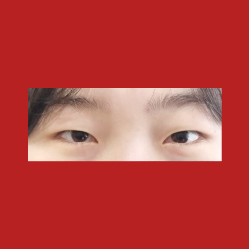 쌍꺼풀(자연유착) 후기