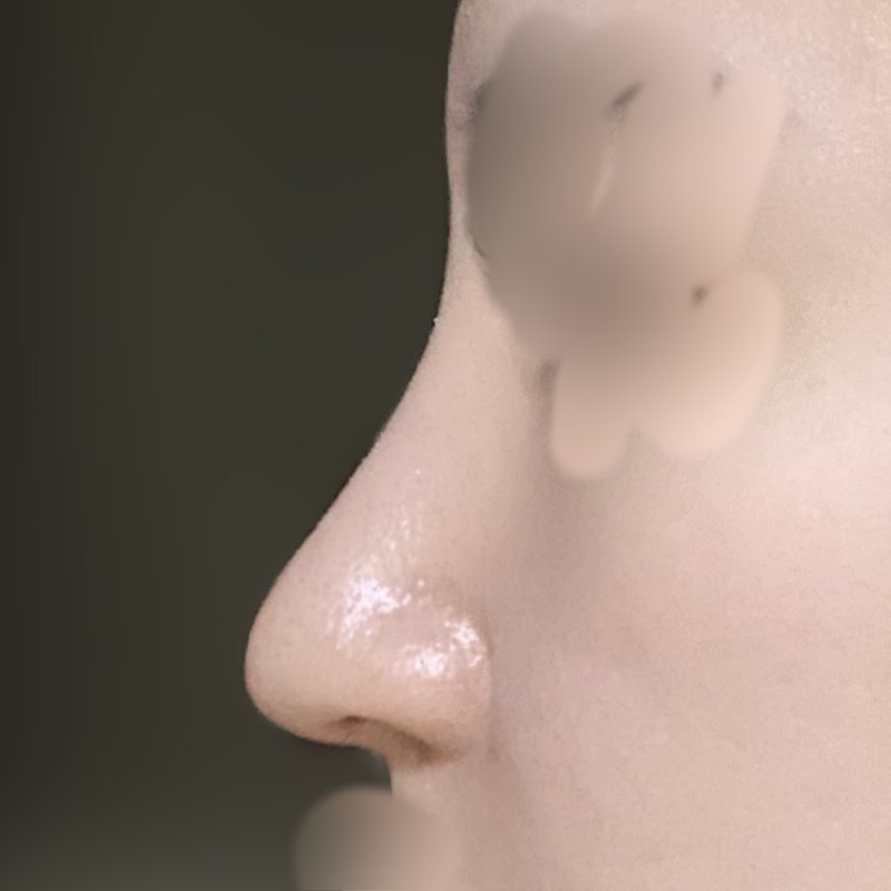 코재수술 후기