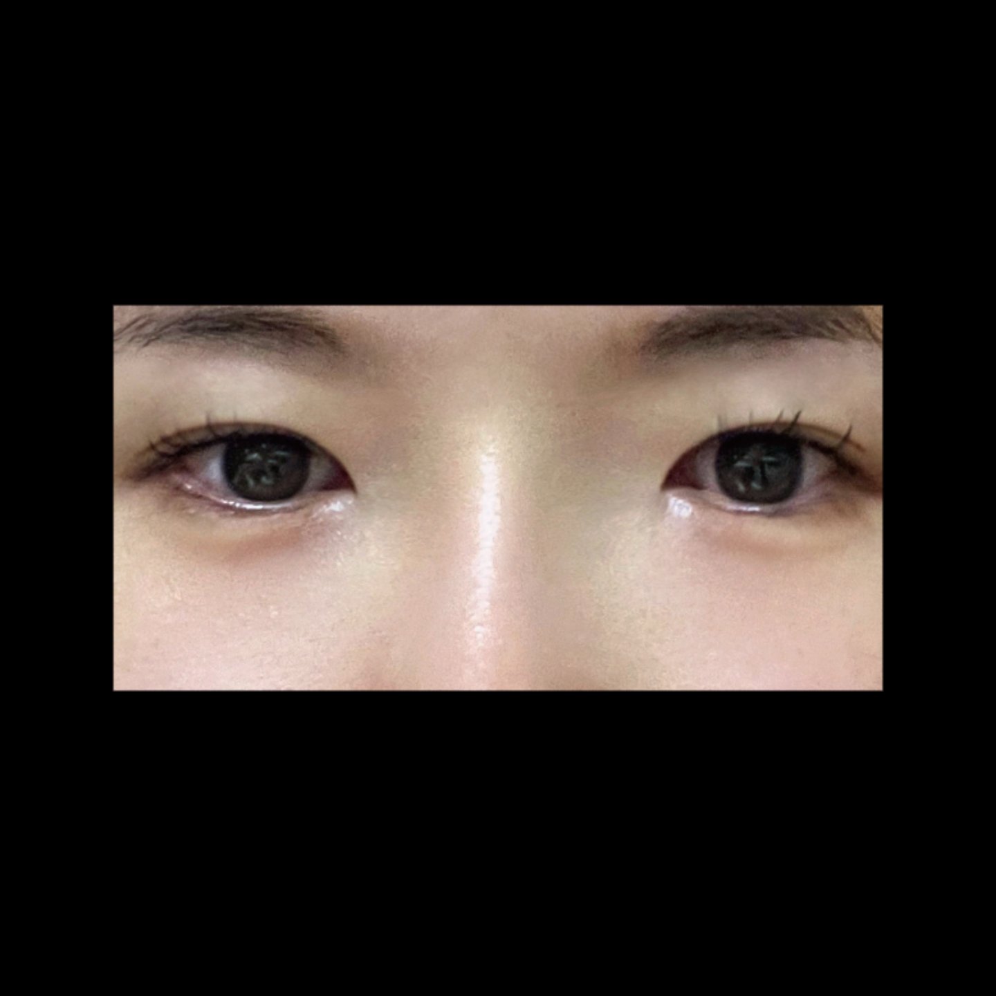 밑트임 후기