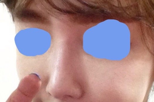 콧대(보형물) 후기