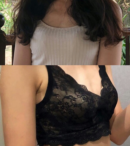가슴(보형물) 후기