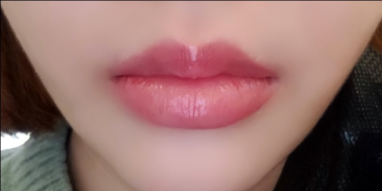 입꼬리성형 후기
