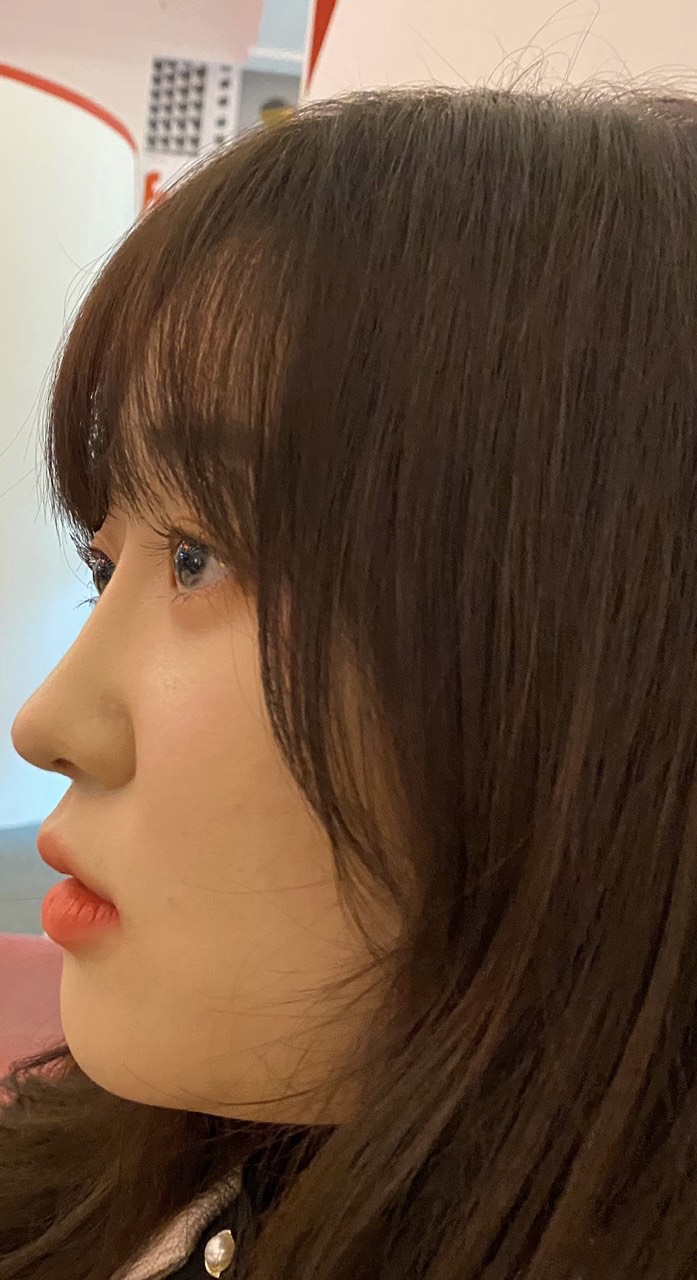 코재수술 후기