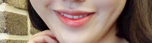 입꼬리성형 후기