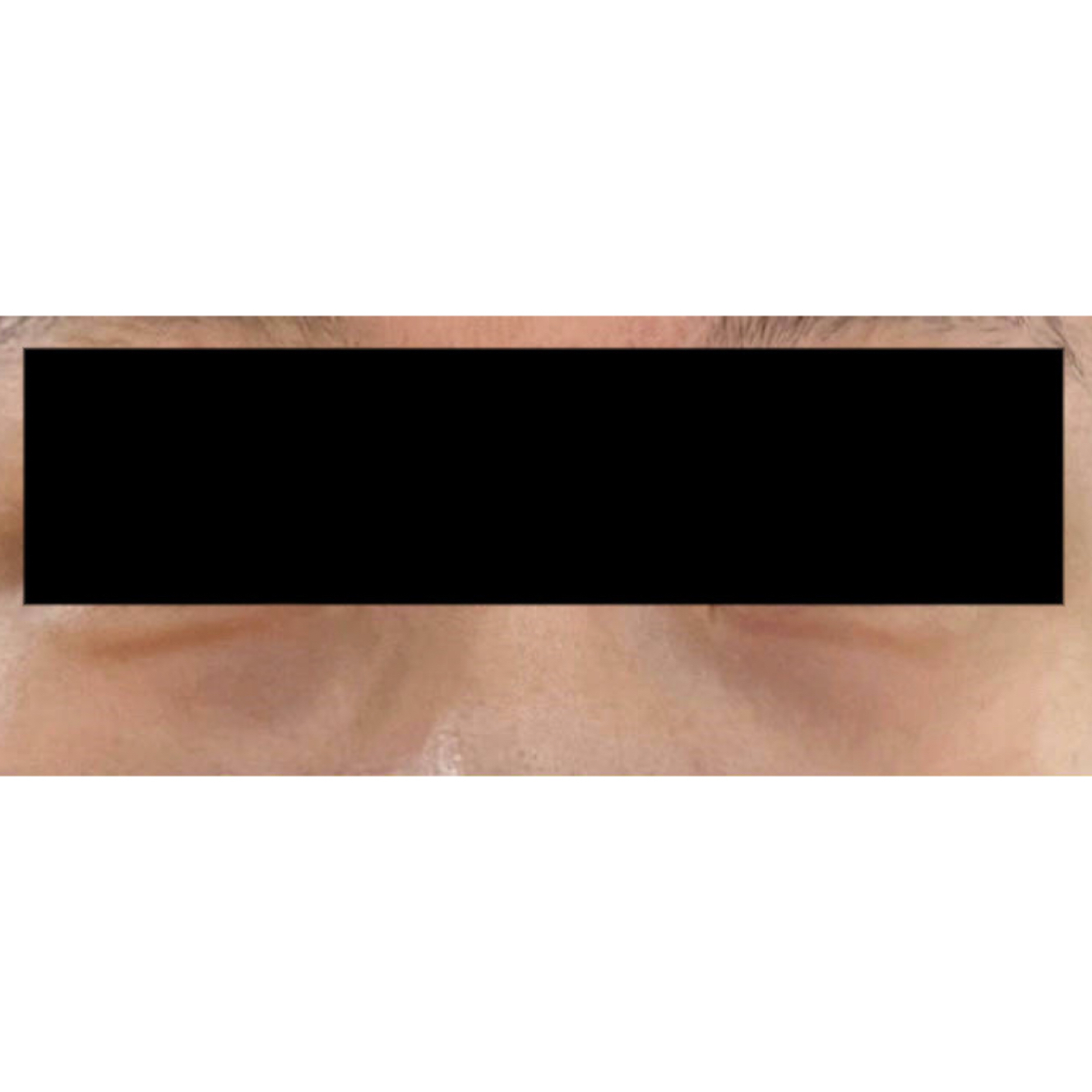 눈밑지방제거 후기