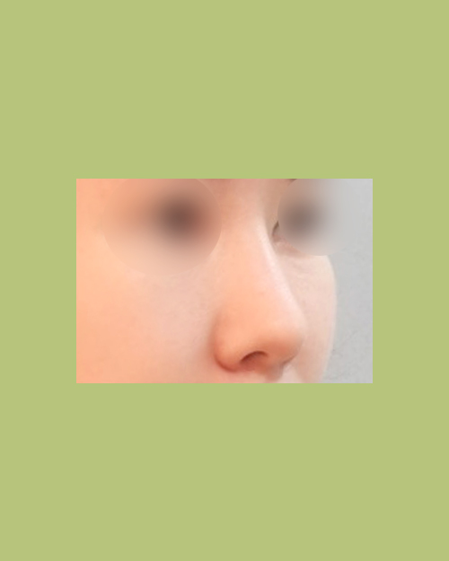 코재수술 후기
