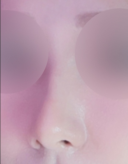 코끝(자가연골) 후기