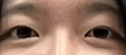 쌍꺼풀(절개) 후기