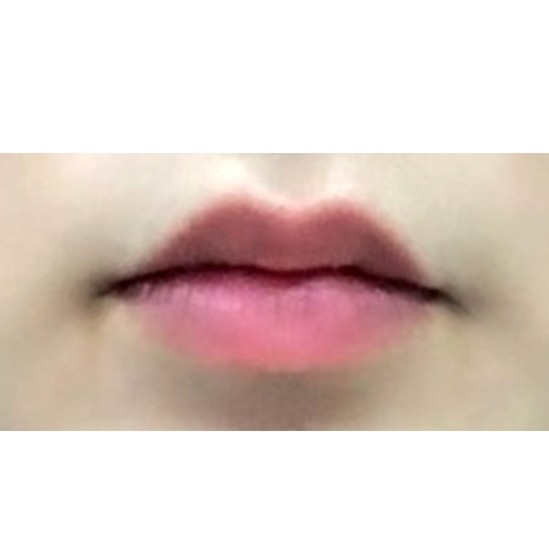 입꼬리성형 후기