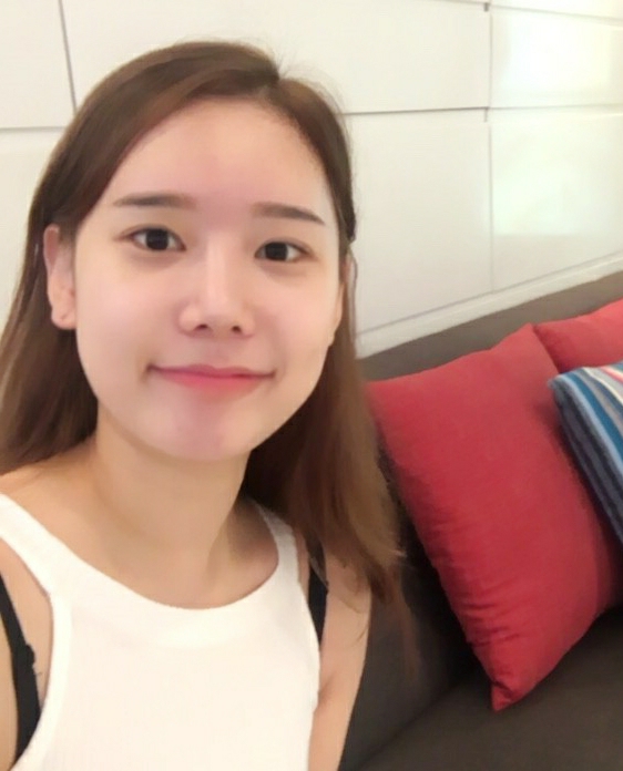 쌍꺼풀(절개) 후기