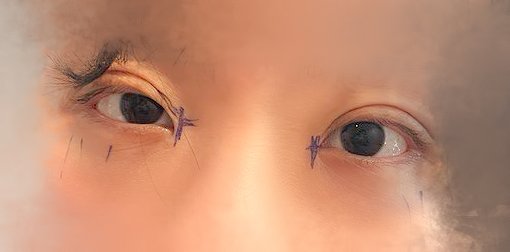 눈재수술 후기