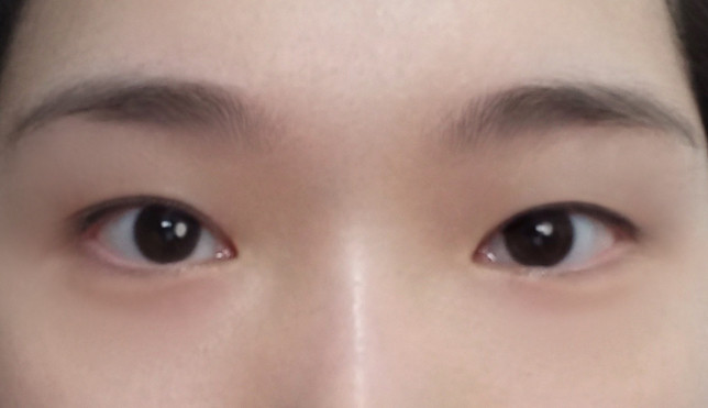 쌍꺼풀(절개) 후기
