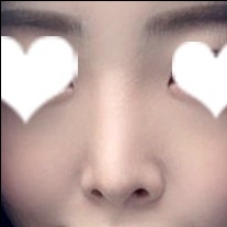 코재수술 후기