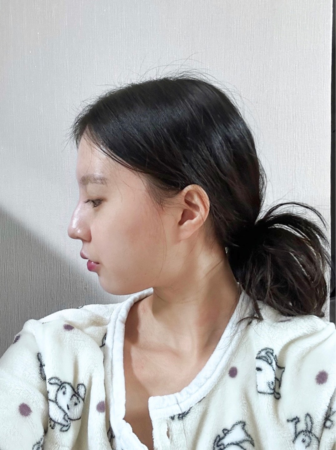 매부리코성형 후기