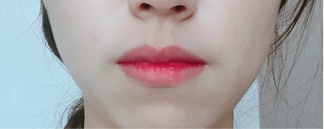 입꼬리성형 후기