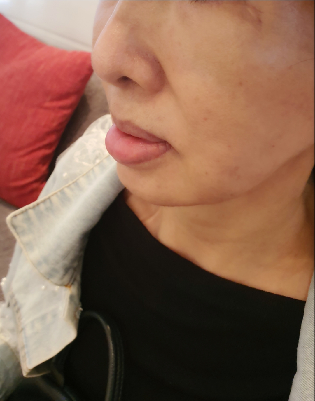 입술이물질제거 후기
