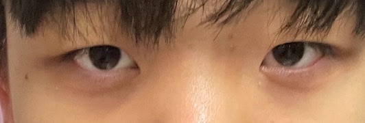 앞트임 후기