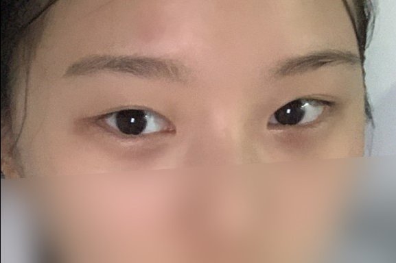 쌍꺼풀(절개) 후기