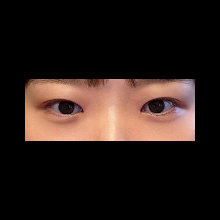쌍꺼풀(절개) 후기