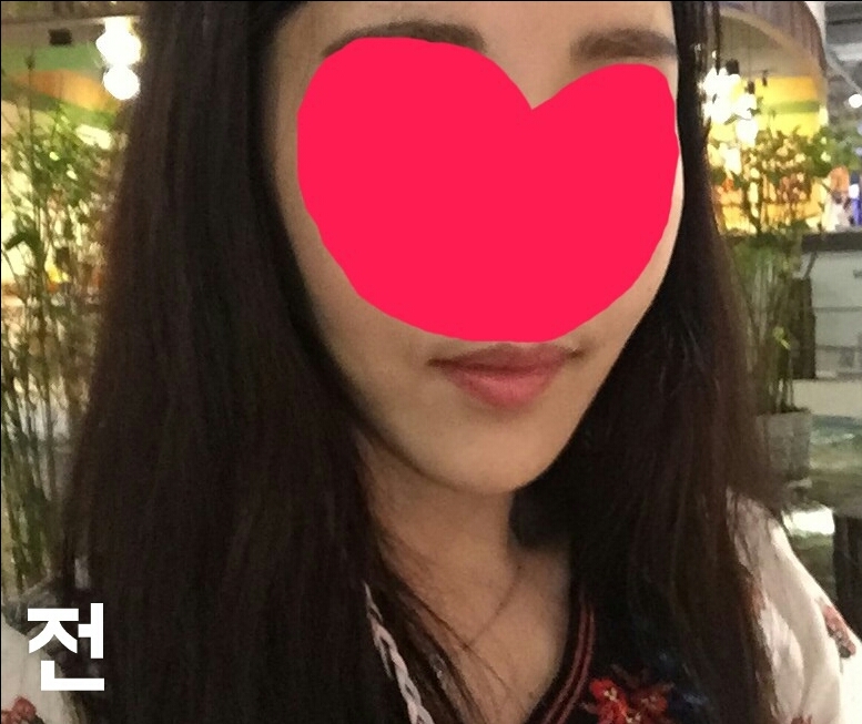 턱끝축소 후기