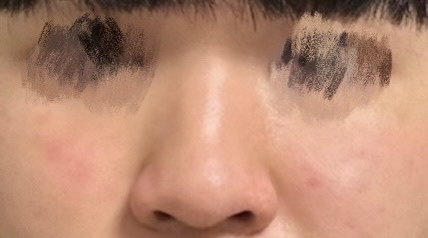 매부리코성형 후기