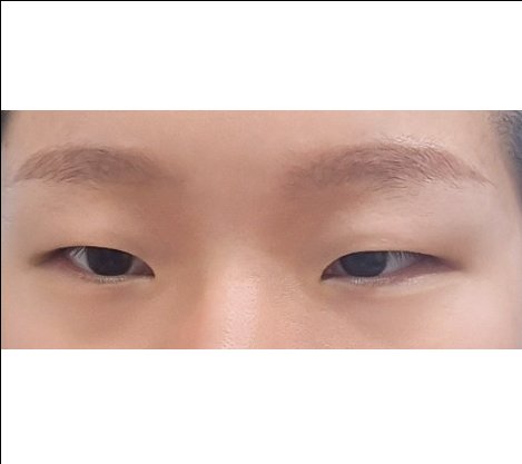 앞트임 후기