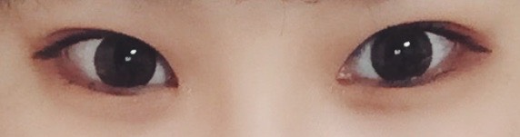 쌍꺼풀(절개) 후기