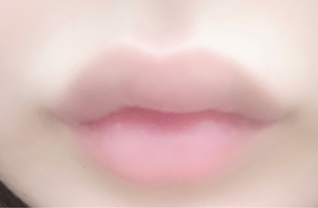 입꼬리성형 후기