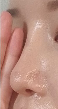 코재수술 후기
