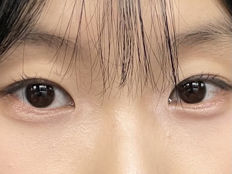 쌍꺼풀(매몰) 후기