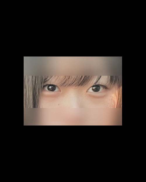 쌍꺼풀(자연유착) 후기