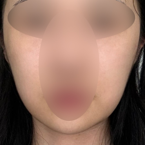 실리프팅 후기