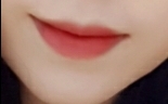 입꼬리성형 후기