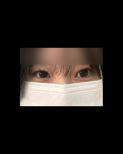 눈재수술 후기