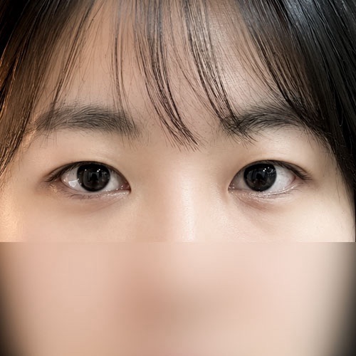 밑트임 후기