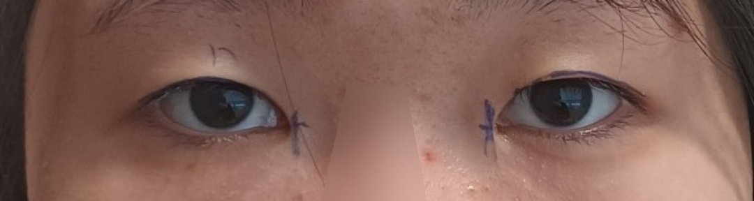 쌍꺼풀(절개) 후기