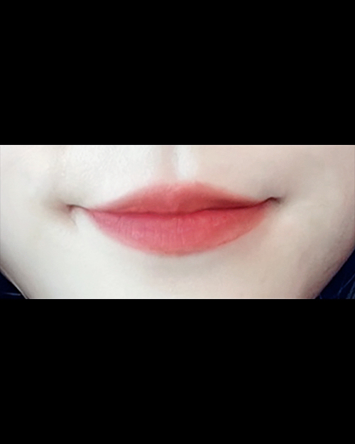 큐피트라인성형 후기