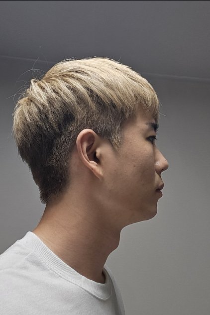 코끝(자가연골) 후기