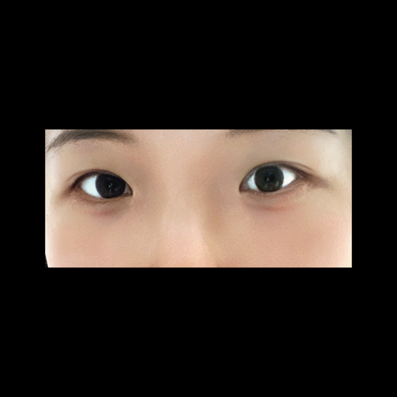 눈재수술 후기