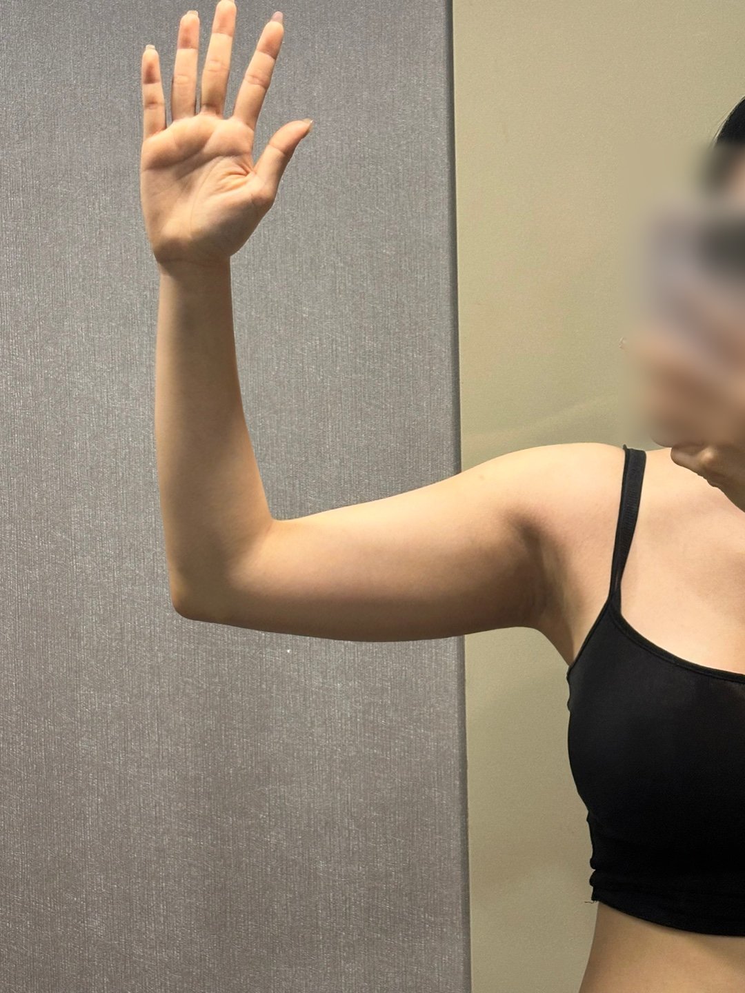 팔지방흡입 후기