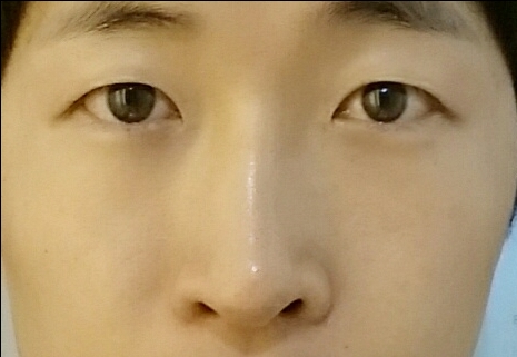 코끝(기증연골) 후기