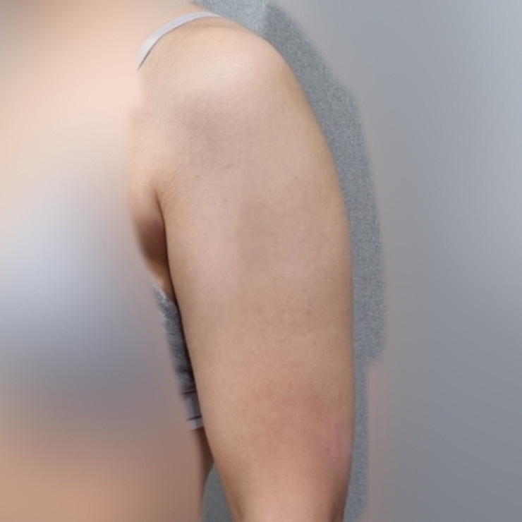 팔지방흡입 후기
