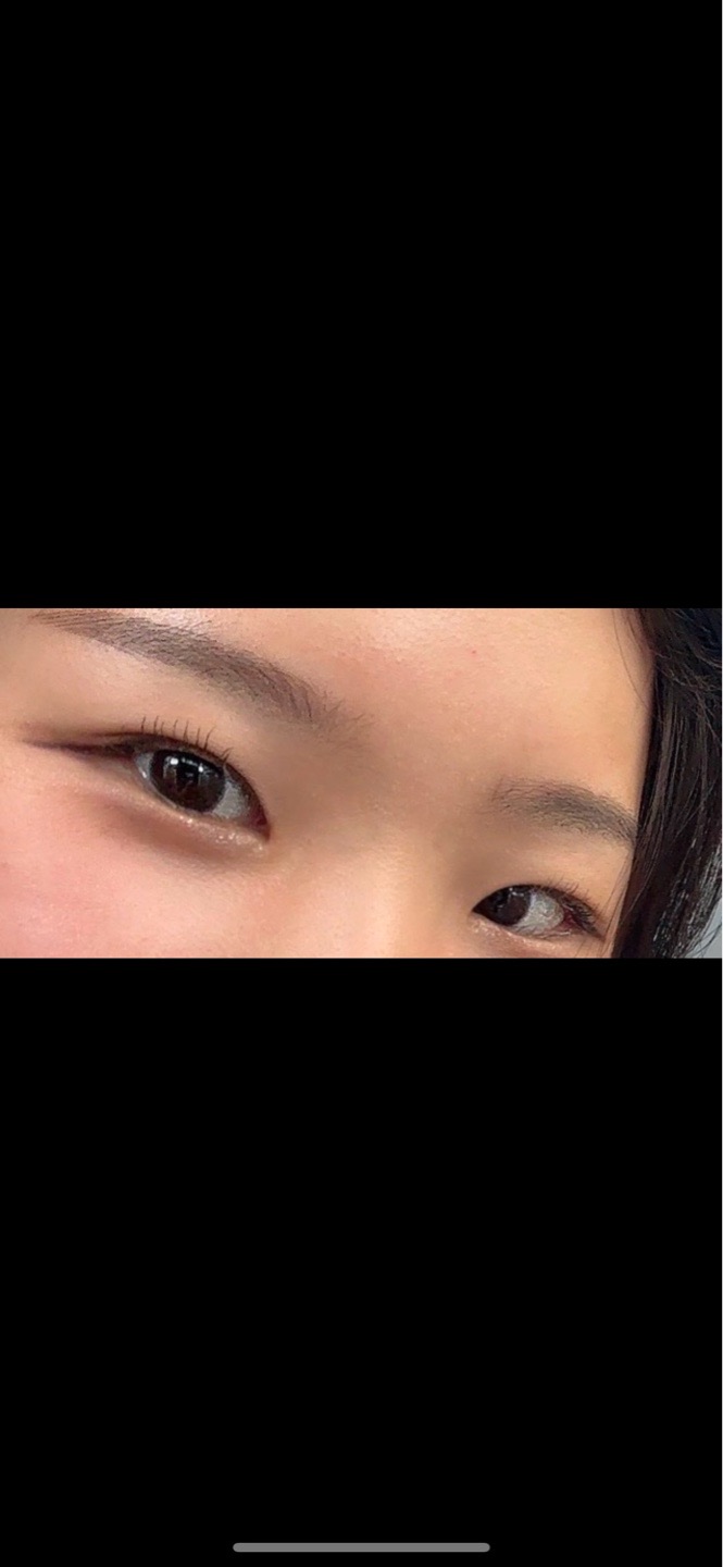 쌍꺼풀(매몰) 후기