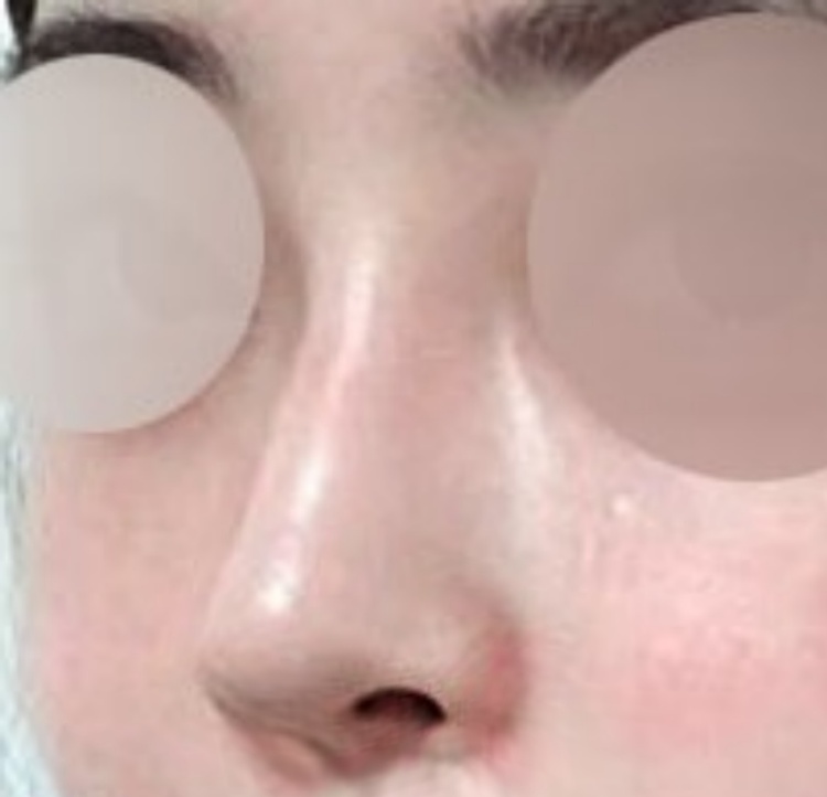 콧대(보형물) 후기