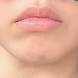 입꼬리성형 후기