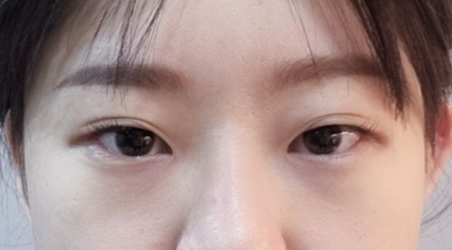 쌍꺼풀(자연유착) 후기