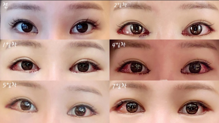 앞트임 후기
