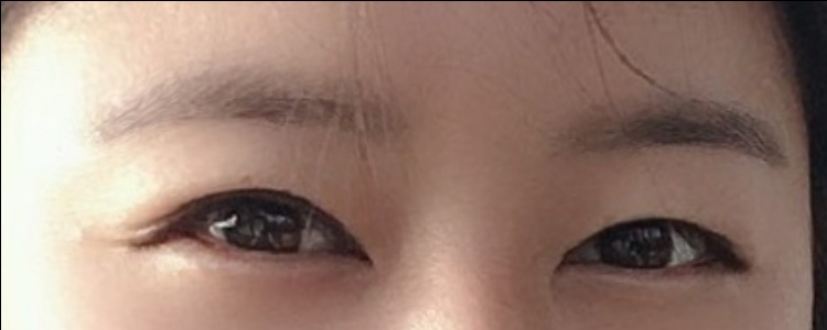 눈재수술 후기
