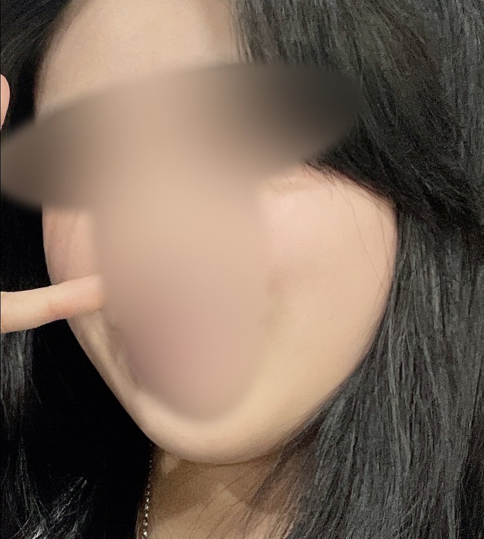 윤곽주사 후기