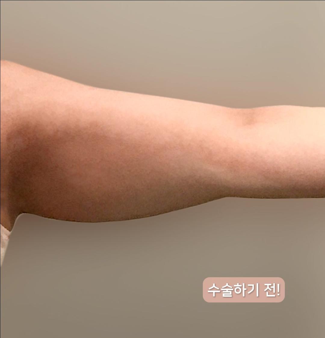 팔지방흡입 후기